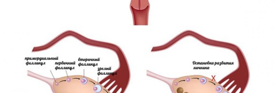 Ановуляция, стимулирование овуляции