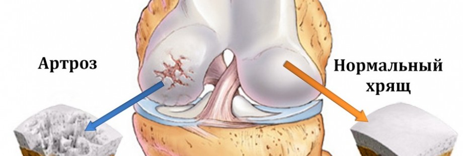 Артроз