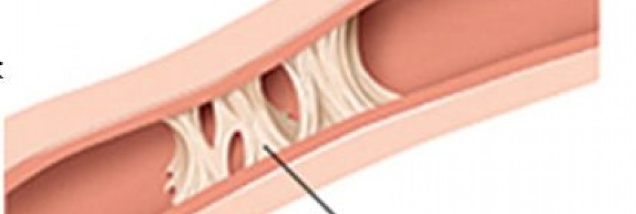 непроходимость маточных труб