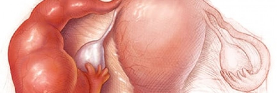 сальпингит сальпигоофорит